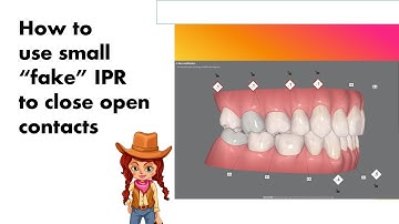 Invisalign ClinCheck - How to use small "fake IPR" to close contacts