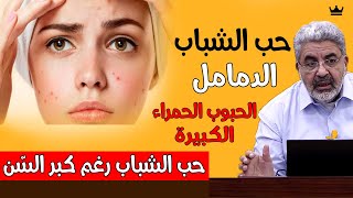 ظهور حب الشباب في الوجه و الدمامل و حبوب حمراء مؤلمة || المراهقين و حتى الكبار ؟