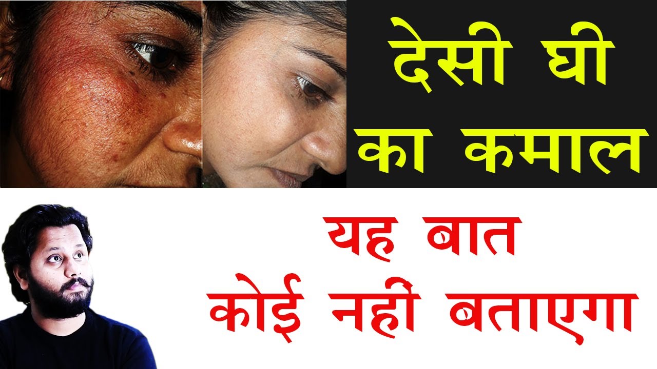 देसी घी का कमाल , यह बात कोई नहीं बताता है ! काला चेहरा, क्रीम के साइड इफ़ेक्ट !Dr Prateek chauhan