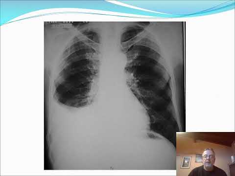 Derrame pleural