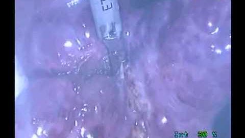 Laparoscopic Resection of HCC in cirrhotic liver by Harmonic scalpel only Dr Hossam Soliman