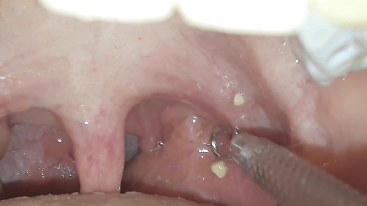 More tonsil stones YouTube