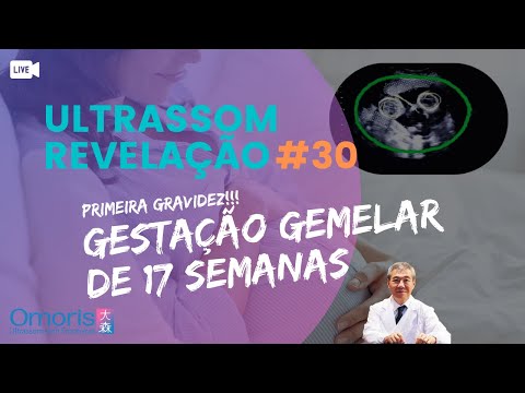 Gestation twins - 17 weeks - Finding out the sex of babies LIVE - Ultrasound Revelation #29