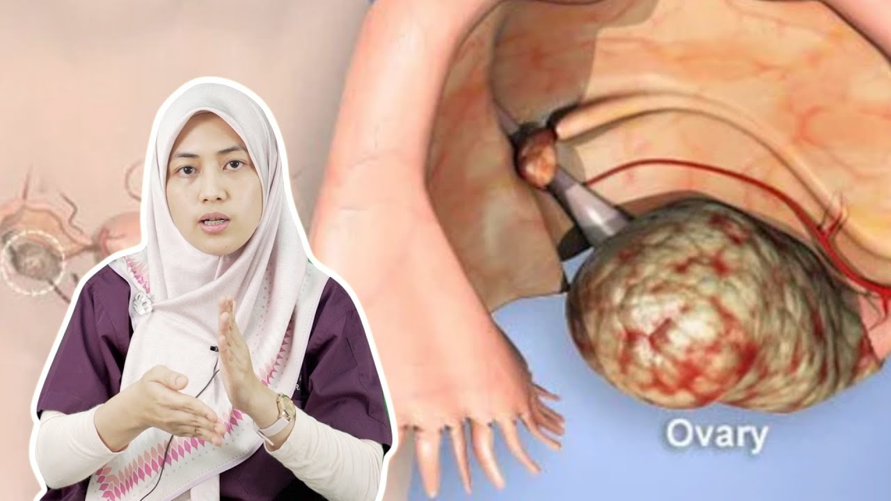 Ini Tanda Anda Ada Kanser Ovari