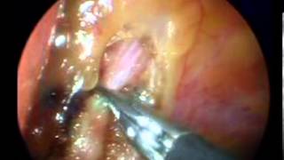 De sintomas sindrome qt largo