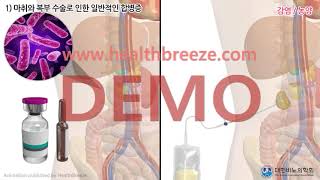 [시연용] c0316aako_[대한비뇨의학회] 복강경 근치적 신장적출술 안내 [동의서용]