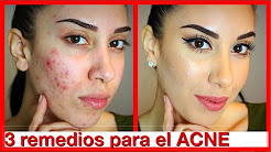 Remedios caseros para el acne - La Guia de Los Remedios