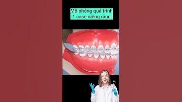Mô phỏng 3d niềng răng#braces #orthodontist