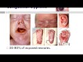 # kassowitz#rule#congenital #syphilistreatment #neet 2025#inicet 2025#biology #recent #mcq #ytshorts