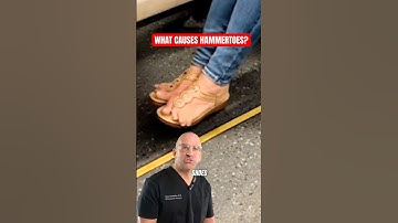 Easy Ways To Fix Hammer Toes At Home!