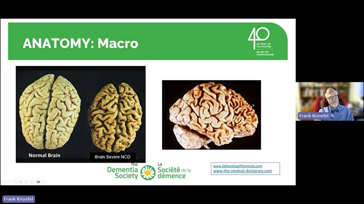 Lewy Body Dementia: What Everyone Should Know with Dr. Frank Knoefel