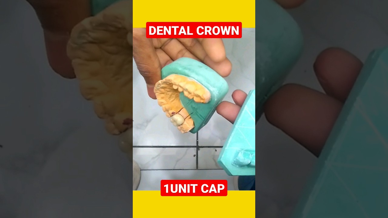 Crown Cutting For DMLS Dental Crown Dental Clinic