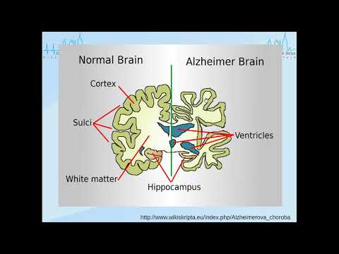Video: Fakta O Alzheimerově Chorobě