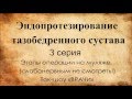 Эндопротезирование тазобедренного сустава. 3 серия. Этапы операции на муляже