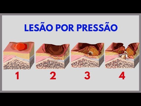 Passo a passo para elaboração do jogo de escape de lesão por pressão.