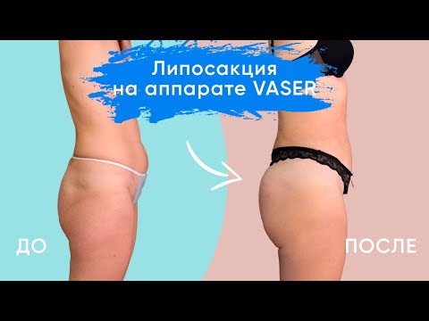 🍦 Ультразвуковая VASER-липосакция для стройной девушки от Кравцевич Валентины Васильевны