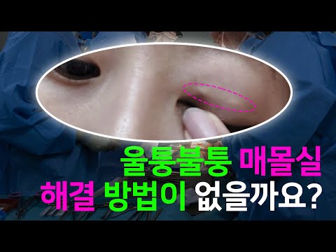성형상담소 💌 I 매듭법 모르는데 매몰실 제거 가능한가요?
