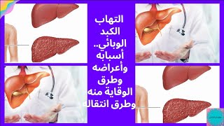 #أسباب وأعراض الإلتهاب الكبدى الوبائى وطرق الوقاية منه