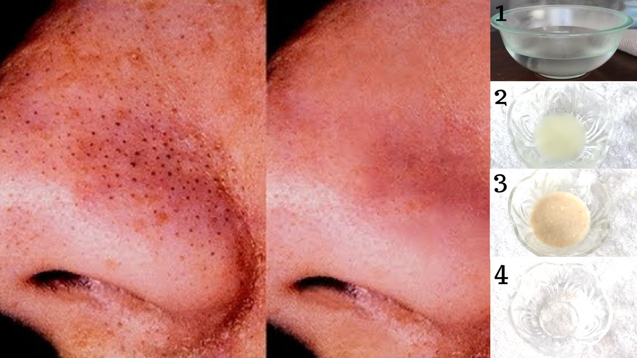 How To Get Rid Of Blackheads And Whiteheads In Just 3 Days | 100%