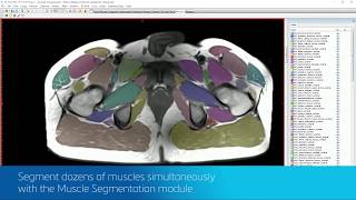 Medical Image Segmentation Made More Intuitive | Mimics Innovation Suite 20.0