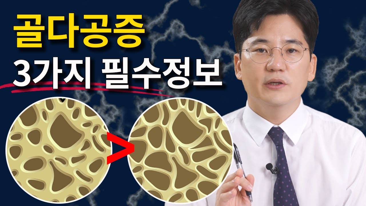 골다공증증상 나도 모르게 찾아옵니다. 골감소증 시작되는 30대부터 주의해야!