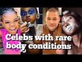 7 Celebs with bizarre body conditions