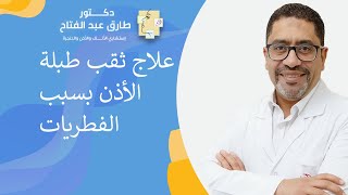 علاج ثقب طبلة الأذن بسبب الفطريات