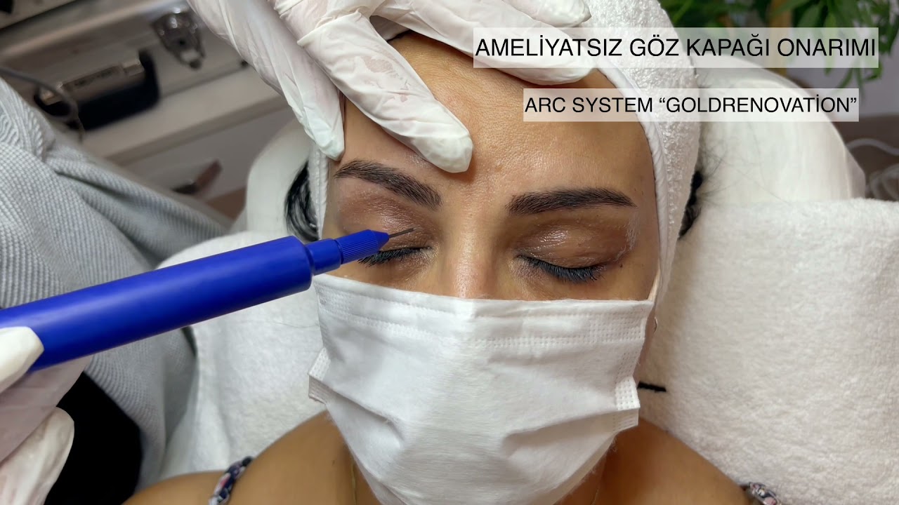 Ameliyatsız göz kapağı düşüklüğü onarımı-Hakan Karanfil “Yeni nesil cilt onarım teknolojileri”