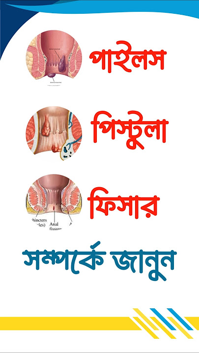 অল্প সময়ে পাইলস, ফিস্টুলা এবং ফিসারের পার্থক্য জেনে নিন।#piles #fistulatreatment#analfissuretreatmen