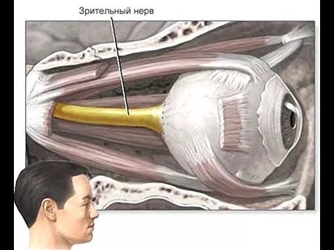 Как вернуть зрение, при атрофии зрительного нерва