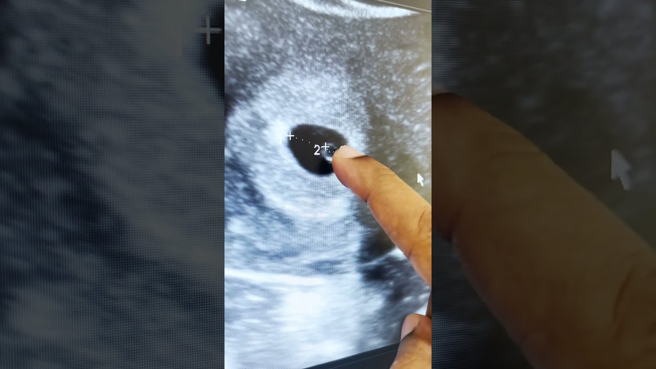 Early pregnancy scans || baby growth on scan || Dr. Silpahasa Samalla | gynaecologist | doctorsvlog