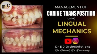 Management of Canine Transposition using  Lingual Orthodontics..