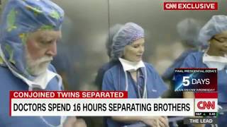 Doctors perform risky surgery to separate conjoined twins