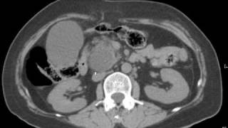 CT interpretation: CBD stone with cholecystitis and IHD stone