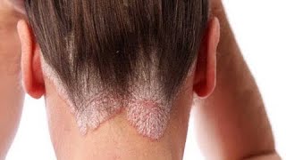 علاج اكزيما الشعر باقوي الاعشاب للقضاء عليه في اسرع وقت