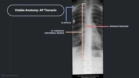 Anatomy on Radiographs of the Thoracic Spine