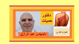 علاج الحزام الناري  HERPES ZOSTER TREATMENT