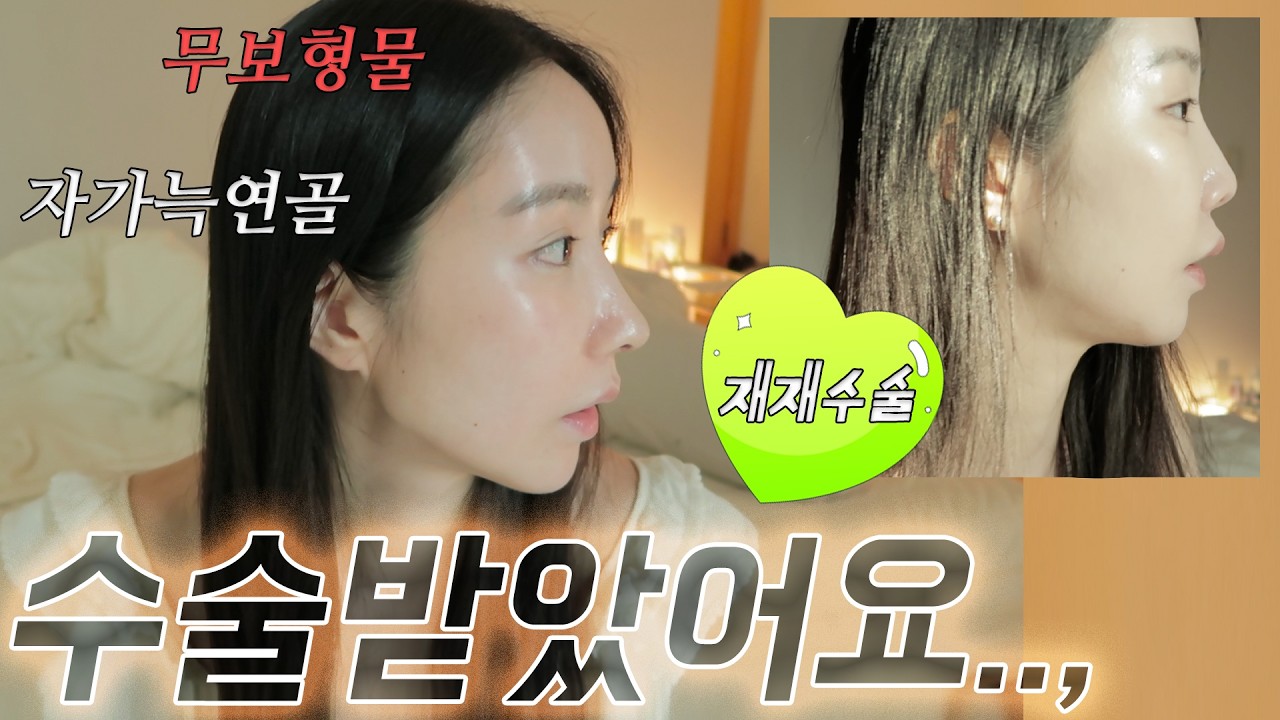 중안부가 짧아지는 비순각교정, 코재재수술 다녀왔습니다.