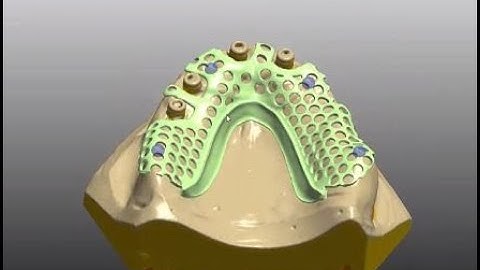 3Shape CAD training overdenture RPD with locator abutments-#9