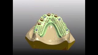 3Shape CAD training overdenture RPD with locator abutments-#9