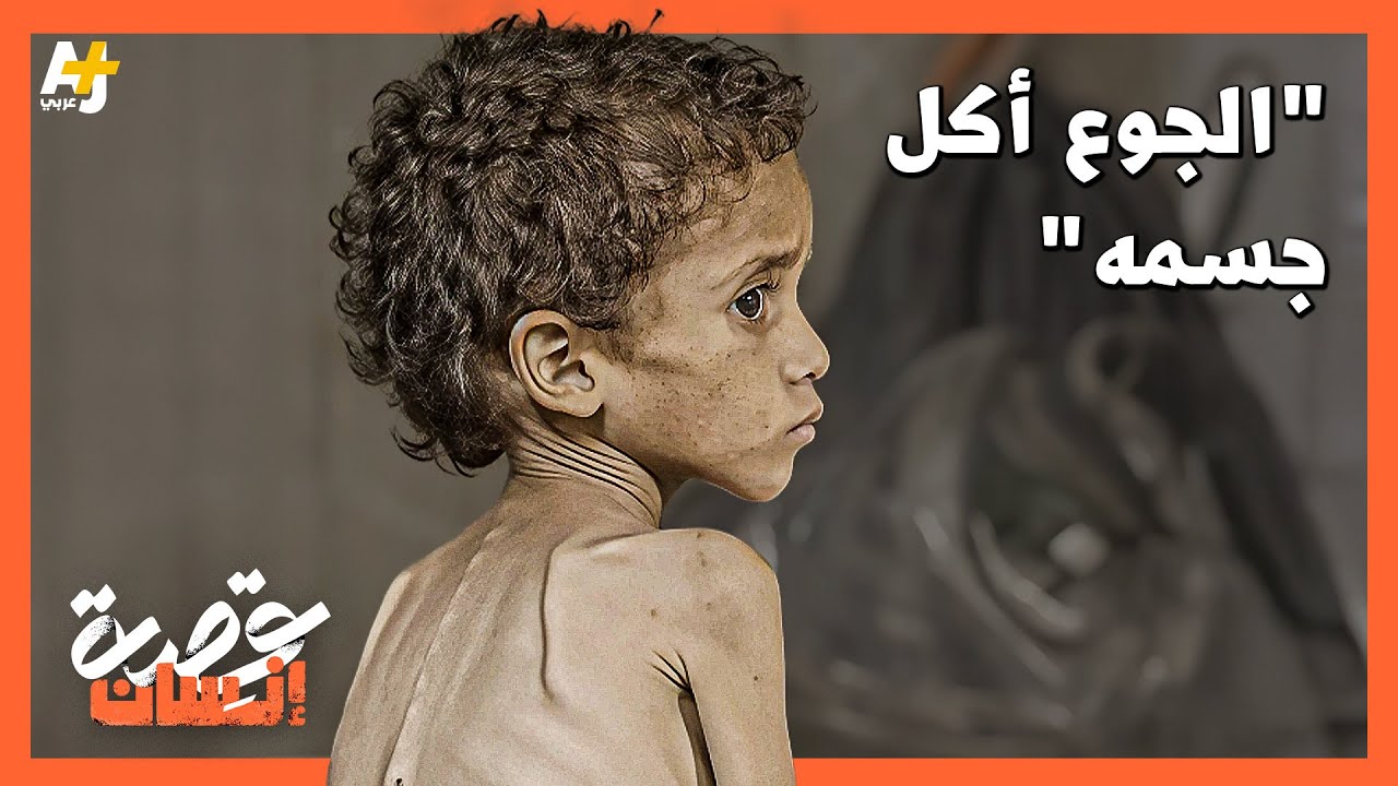 الجوع يأكل جسم الطفل يزن في غزة