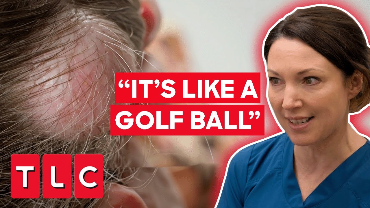 Dr. Emma Helps Woman With Cyst Like A “Golf Ball” The Bad Skin Clinic