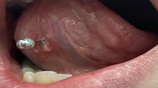 how long does a tongue piercing take to close