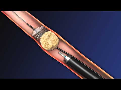 CoAx 10mm Stone Control Catheter from Accordion Medical