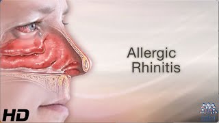 ALLERGIC RHINITIS: Everything You Need To Know