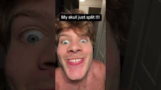 My mid palate suture my maxilla split successfully from my palate expansion procedure
