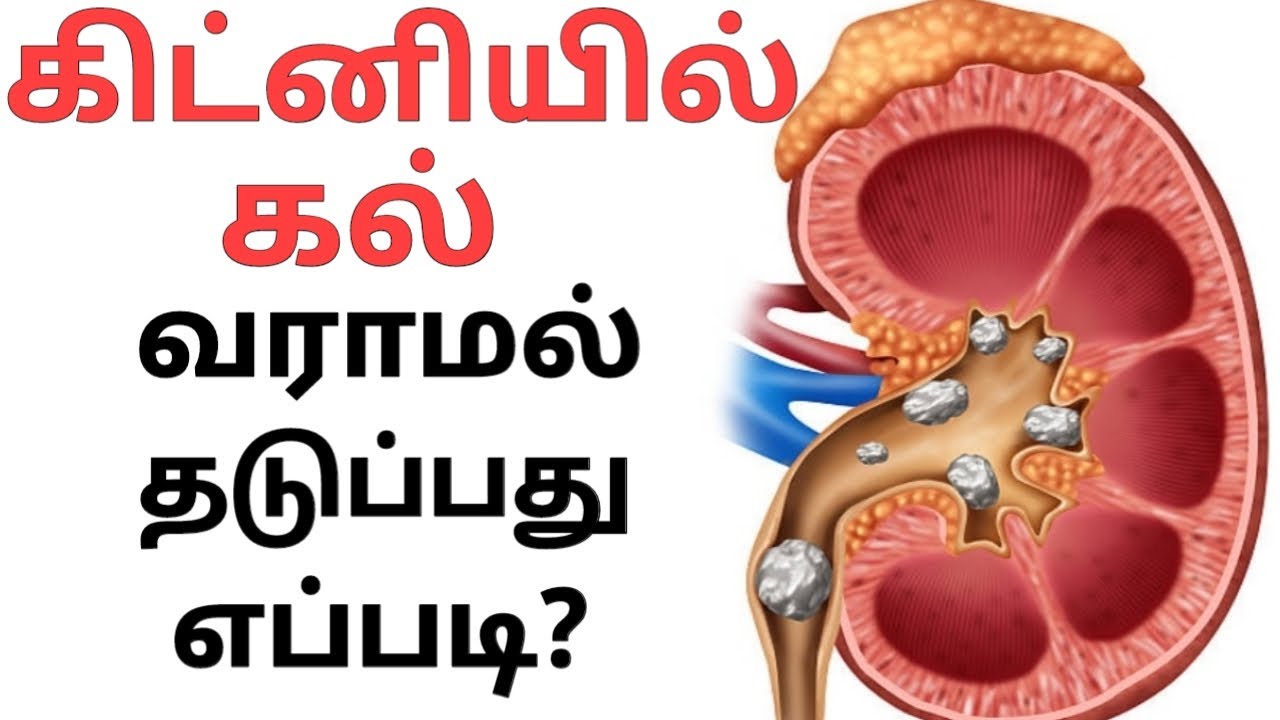 How to cure kidney stone in tamil/foods avoid for kidnwy stones in