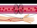 A new method for tracking endothelial dysfunction and heart disease risk in patients with diabetes