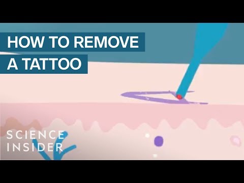 Video: Hoe werkt het verwijderen van tatoeages?