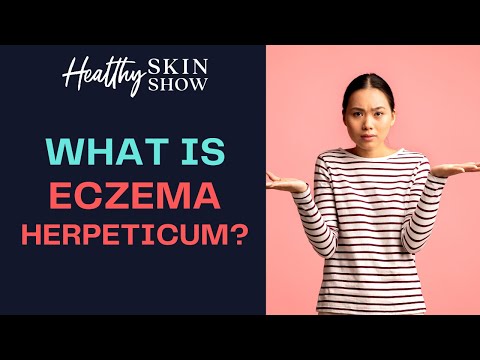 What The Heck Is Eczema Herpeticum?
